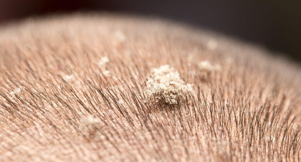 TYPE OF DANDRUFF AND LICE