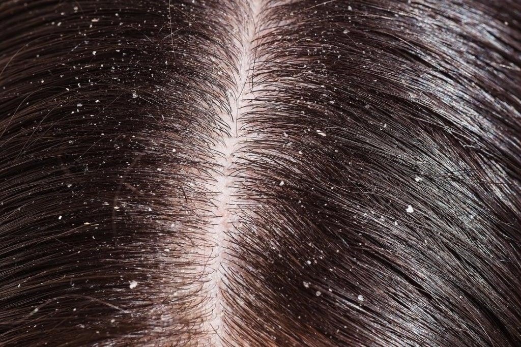 Fascinating home remedies to get rid of dandruff & lice