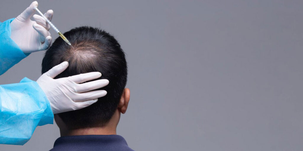 PRP-injection-into-your-scalp