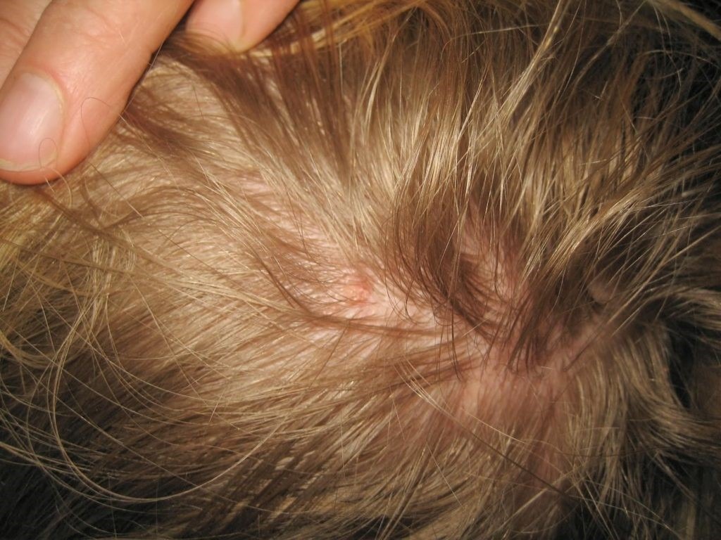 REMOVE DANDRUFF AND LICE