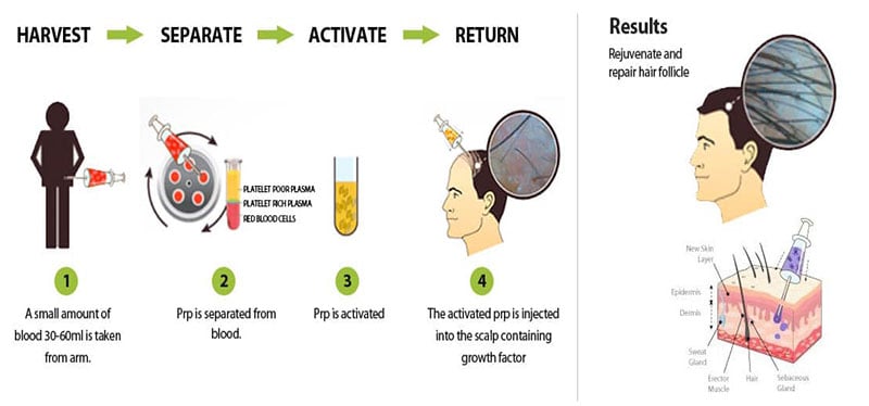 prp-hair-treatment-cost